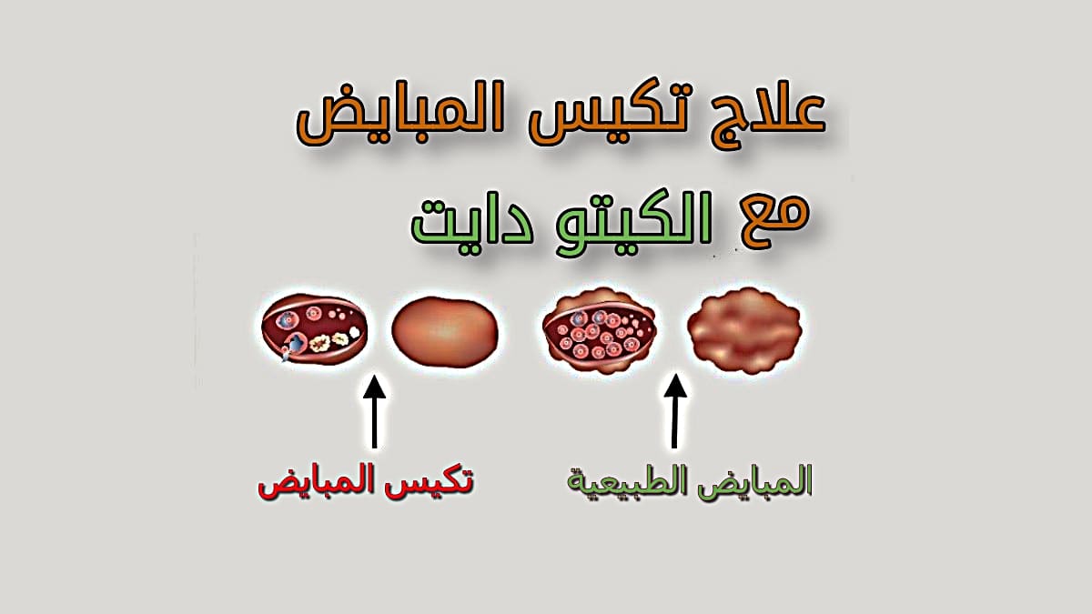 علاج التكيس , ماهو مرض تكيس المبايض