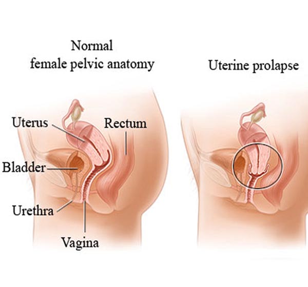 اعراض هبوط المهبل - اسباب واعراض وعلاج هبوط المهبل لدي المراة 11337 2