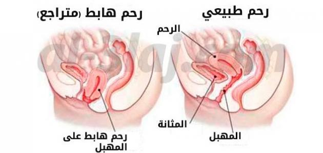 اعراض هبوط المهبل - اسباب واعراض وعلاج هبوط المهبل لدي المراة 11337 3