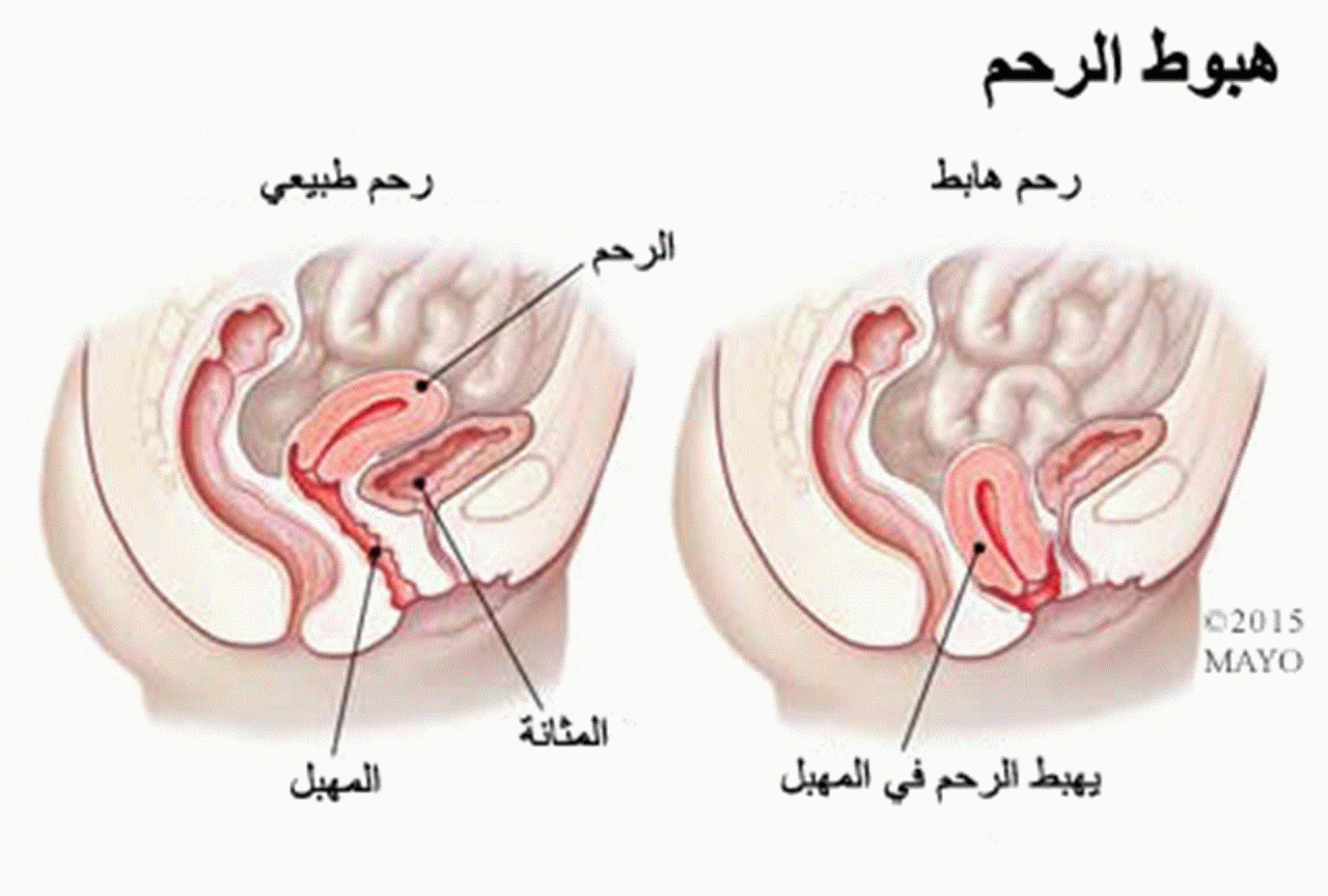 اعراض هبوط المهبل - اسباب واعراض وعلاج هبوط المهبل لدي المراة 11337