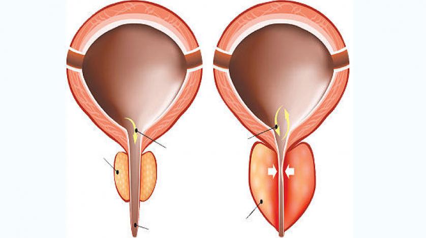 اسباب تضخم البروستاتا - البروستاتا امراضها واسبابها 2968 1