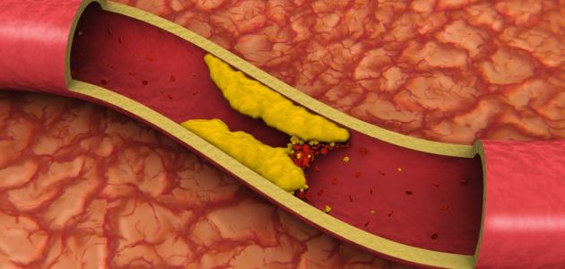 ما هو Ldl Cholesterol- ما هو معدل الكوليسترول الطبيعي 11288 1