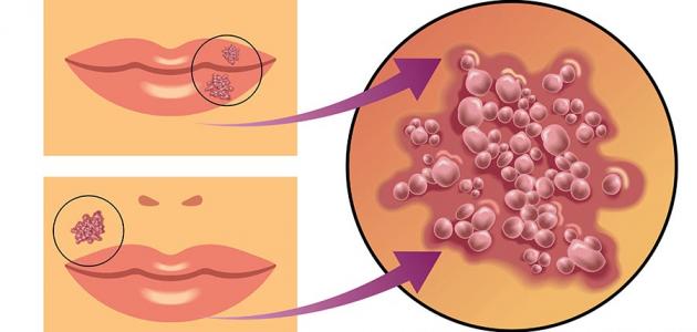 مرض الهربس , تعرف على مرض الهربس و انواعه