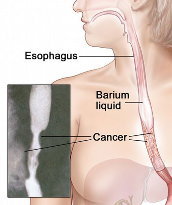 اعراض سرطان المريء - اسباب سرطان المرىء 4043 2