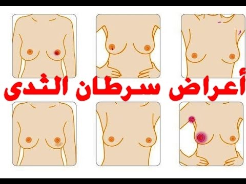 اعراض سرطان الثدي - علامات الاصابه بسرطان الثديين 214 2