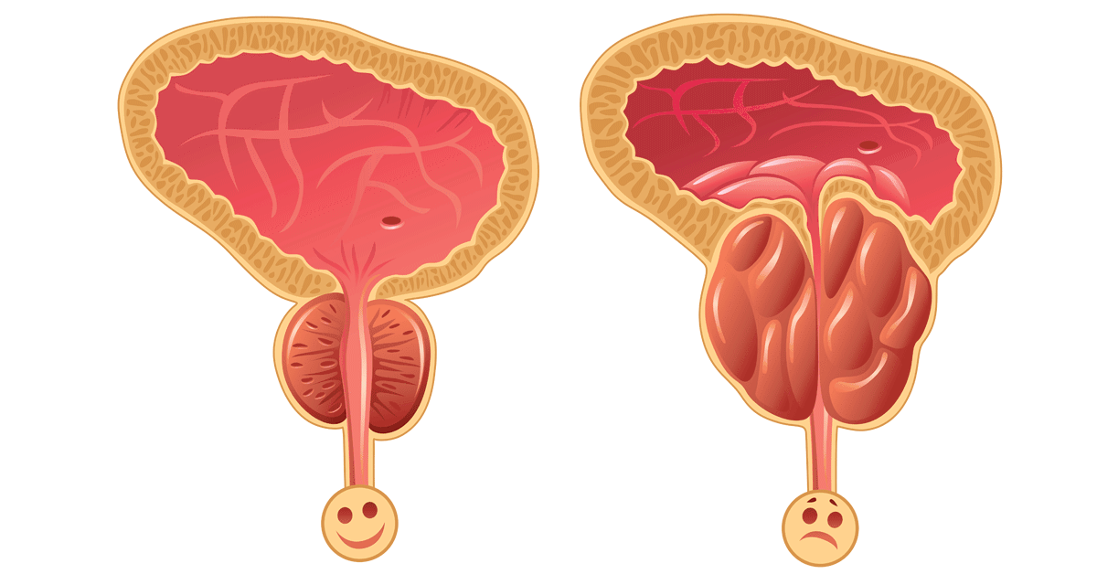 البروستاتا عندي ضخمة جدا - علاج تضخم البروستاتا 2004