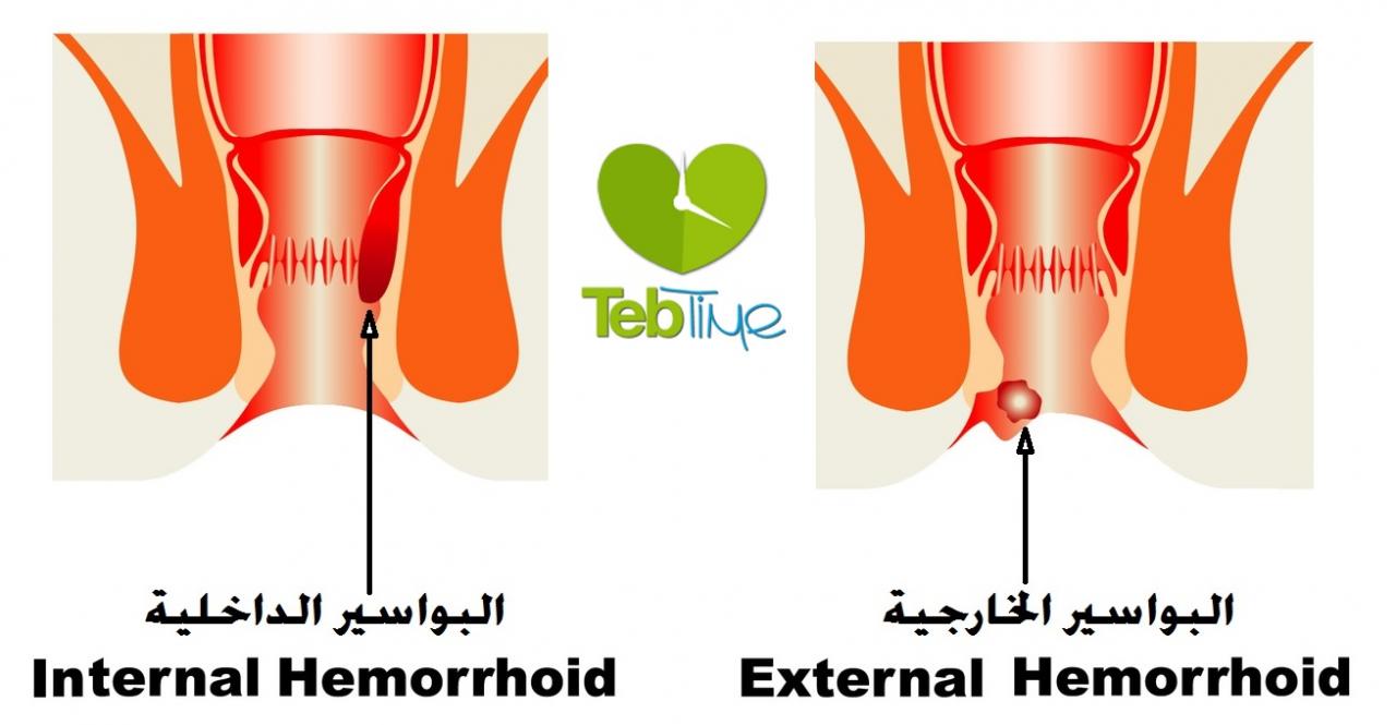 اسباب البواسير - الاعراض المزمنة لمرضي البواسير 404 1