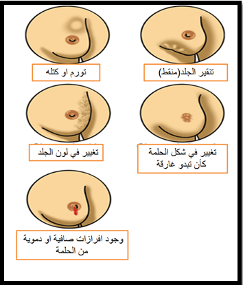 مرض سرطان الثدي - امراض الثدى وخطورتها 6273 1