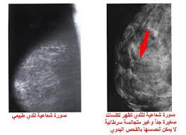 مرض سرطان الثدي - امراض الثدى وخطورتها 6273 5