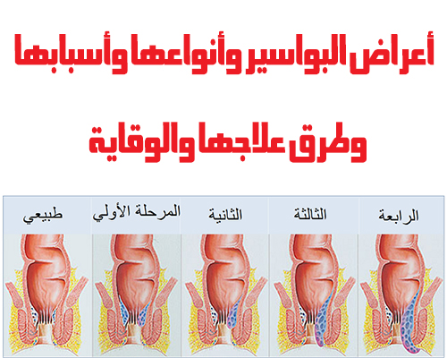 اعراض البواسير - هل تعرف ما هى اسباب و اعراض البواسير - 4603 3