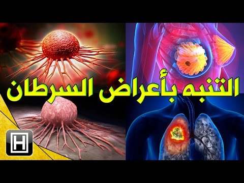 اعراض مرض السرطان , تعرف على اعراض مرض السرطان Cancer