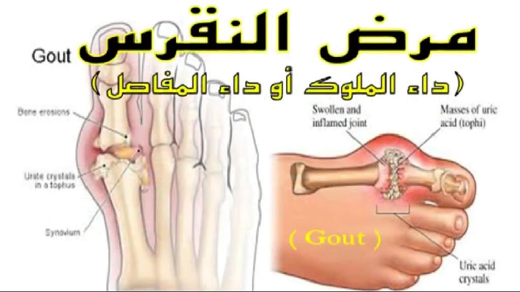 علاج النقرس , طريقة للتخلص من النقرس