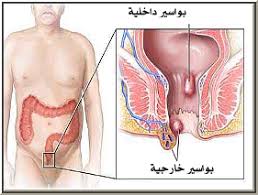 علاج البواسير , علاجات حديثه للبواسير