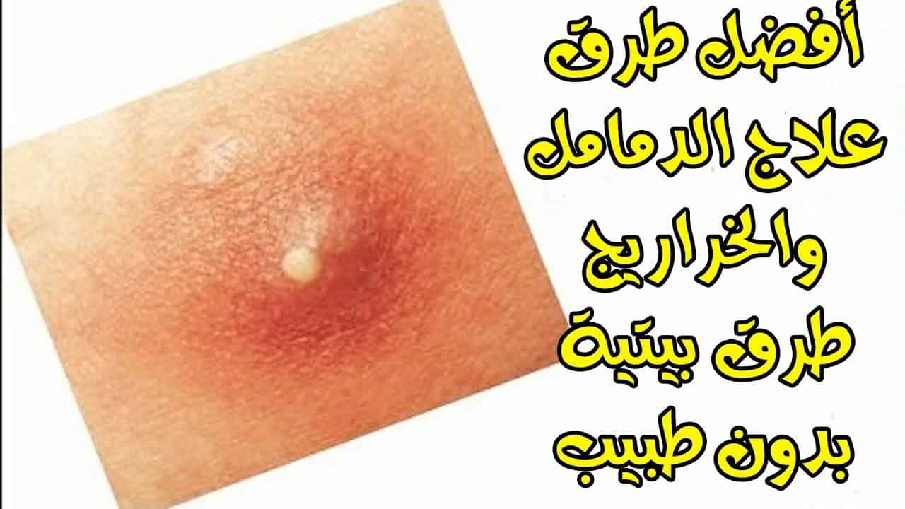 علاج الدمل